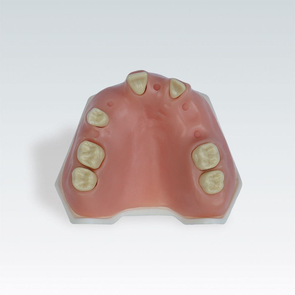 A-PB PI Стоматологическая модель верхней челюсти с периимплантитом