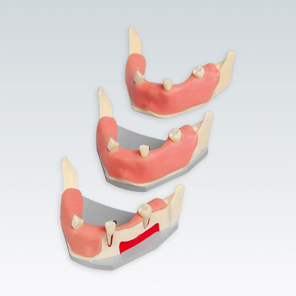 A-J F UKW Стоматологическая модель нижней челюсти для имплантации со слизистой